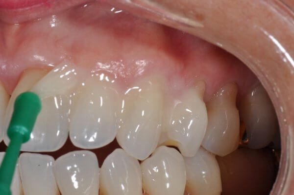 реминерализация эмали зубов в домашних условиях